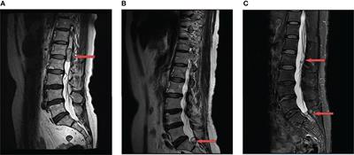 Anlotinib for the Treatment of Multiple Recurrent Lumbar and Sacral Cord Hemangioblastomas: A Case Report